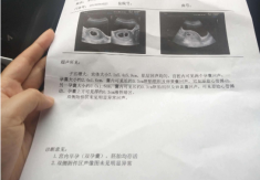来自河南的魏女士患多囊卵巢 做第三代试管婴儿顺利移植龙凤胎
