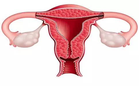 子宫内膜异位症适合做三代试管婴儿吗？
